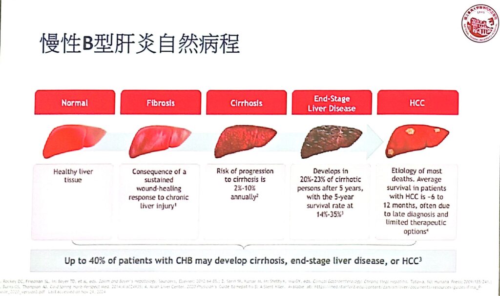 省略「肝硬化」直接變「肝癌」,台灣B型肝炎定期篩檢率不到7成:慢性肝炎監測建議納入FIB-4 指標 1 1975年起全面接種B肝疫苗,2000年代藥物納健保,降低惡化與肝癌風險。但仍有190萬名未接種帶原者,定期追蹤率不足7成。B肝不必進展到肝硬化才可能致癌,尤其20–40歲免疫清除期風險高。國內藥物給付比國際嚴格,應放寬病毒量門檻並同步國際治療標準。