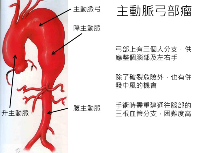 主動脈瘤如不定時炸彈,超過6公分破裂機率大增:榮總引進「客製化開窗支架」創新治療免開胸繞道更安全 1 主動脈弓部上方有三根重要的分支血管,負責供應整個腦部以及左右手。手術時需重建通往腦部三根血管分支,困難度高。