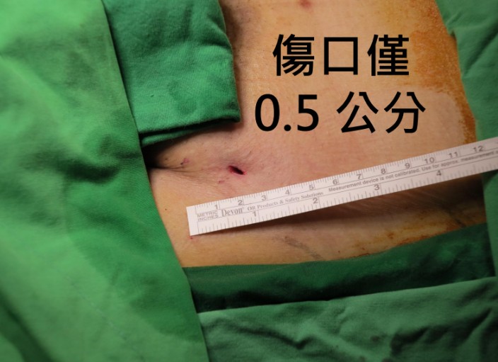 主動脈瘤如不定時炸彈,超過6公分破裂機率大增:榮總引進「客製化開窗支架」創新治療免開胸繞道更安全 2 臺北榮總引進「客製化主動脈開窗支架」手術,相較於傳統手術傷口極小,手術時間大幅縮短,也降低麻醉風險。特別適合高風險族群。