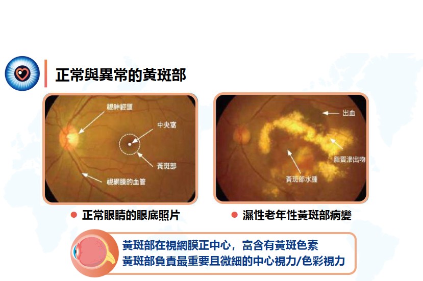 黃斑部病變是視力喪失主因,近視每多100度增加6成風險:自我檢測出現視力扭曲、模糊、黑點或顏色黯淡務必盡快就醫 2 台灣高齡化加劇,視力病變風險上升。2023年因眼疾就診人數逼近721萬,僅三成民眾定期檢查。黃斑部病變常見於老年人,現已蔓延至中壯年。五大風險因子包括:年齡超過50歲、家族病史、吸菸、高血壓/高血糖/心血管疾病、BMI過高,以及近視度數增加。病變類型多元,包括糖尿病黃斑部水腫、濕性老年黃斑部病變(nAMD)及脈絡膜息肉樣血管病變(PCV)。專家建議,若有視力模糊、扭曲、黑點或顏色變暗,應及早檢查並可用阿姆斯勒方格表自我檢測。