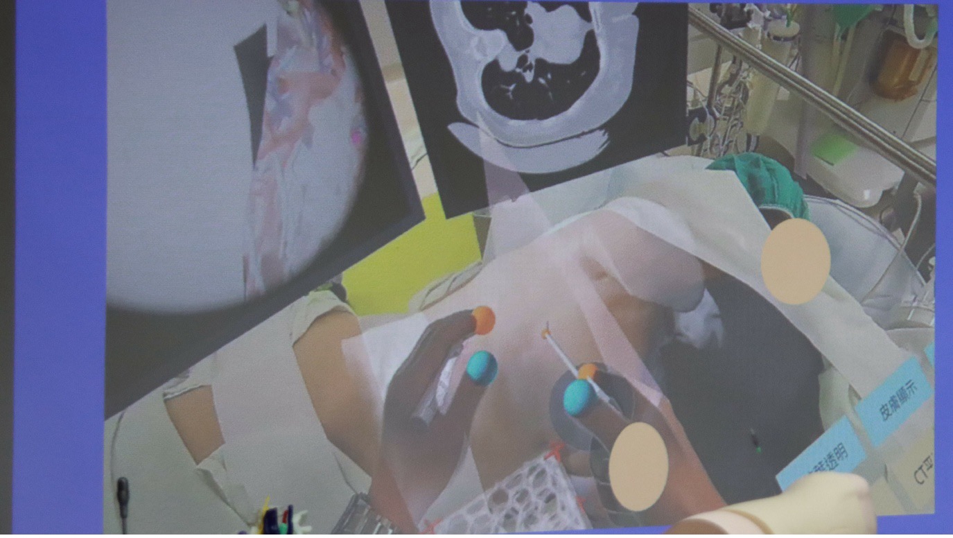 OpVerse結合元宇宙與數位孿生技術，能精準提升手術效率與安全，並應用於多項微創手術及沉浸式醫學教育。未來延展實境設備預計將更輕巧便利，為醫療元宇宙開創新局。