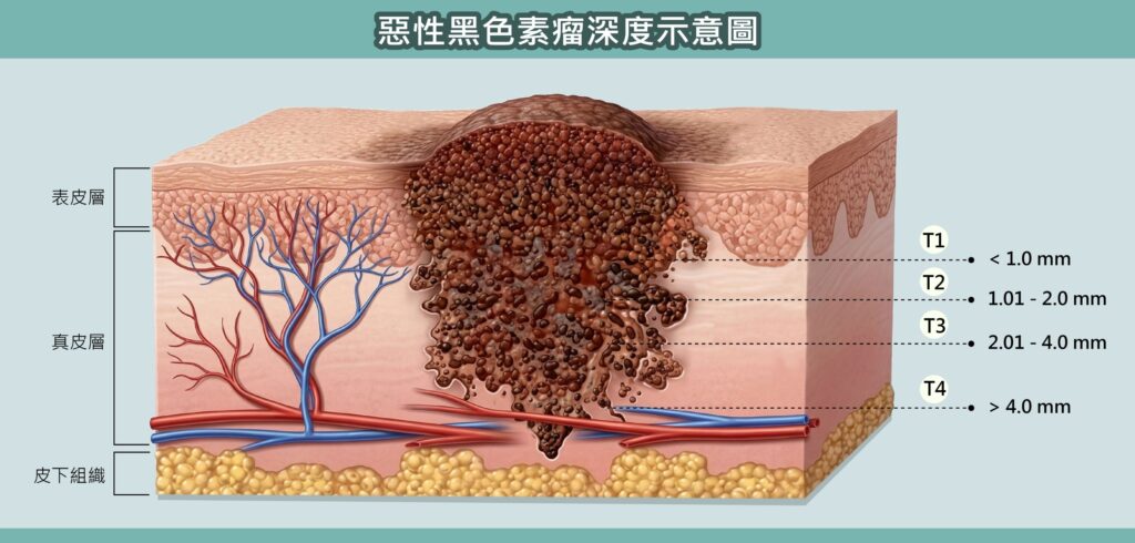 黑色素瘤症狀是甲溝炎?亞洲族群高風險別忽略「皮膚癌之王」警訊 2 黑色素瘤深度分期示意 T1到T4皮膚侵犯層次