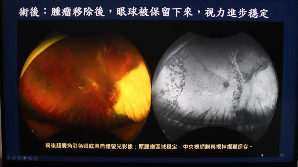脈絡膜黑色素瘤治療前評估與保留眼球治療策略